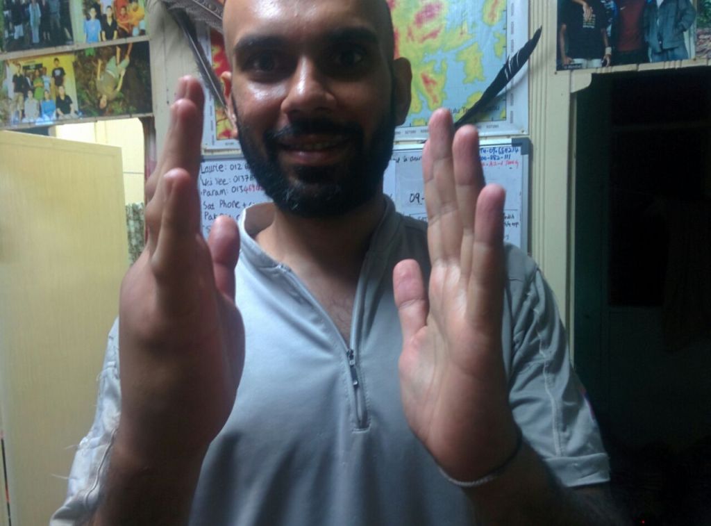 Jasdev with a 'hands-on' experience with a wasp sting